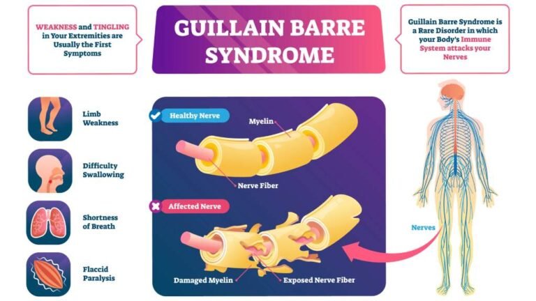 Guillain-Barré Syndrome from Flu Vaccine